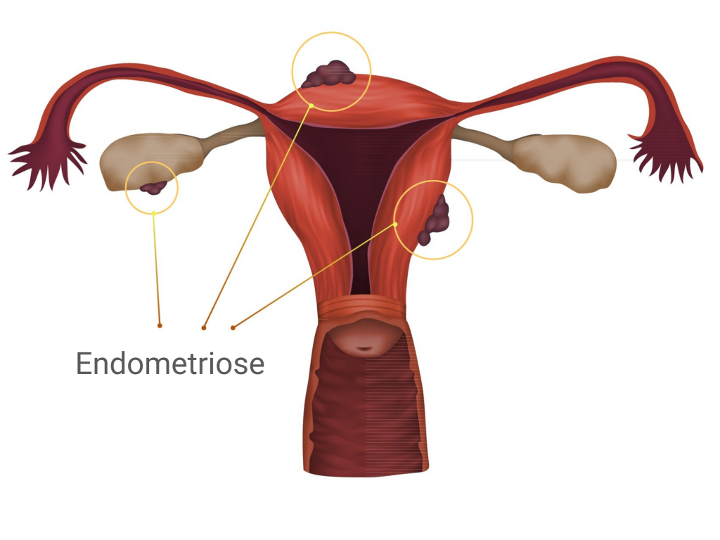 Endometriose